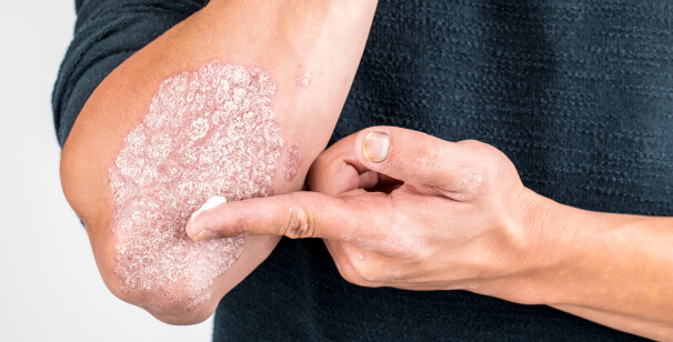 Psoriasis and Eczema